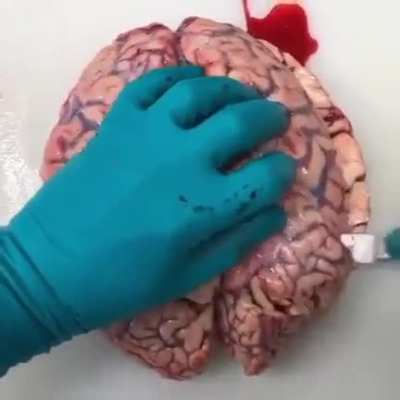 Intracerebral hemorrhage discovered during brain autopsy
