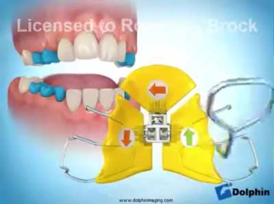 You know 3-way expander??