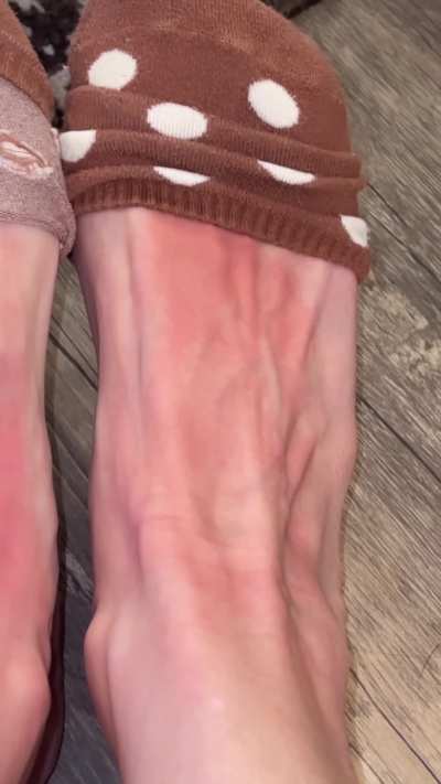 Sunburnt