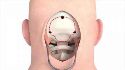 How a craniectomy is performed to remove a tumor from the brain.