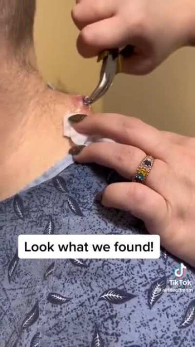 Guy was shot 7 times and hospital staff somehow missed this bullet [Not OC]