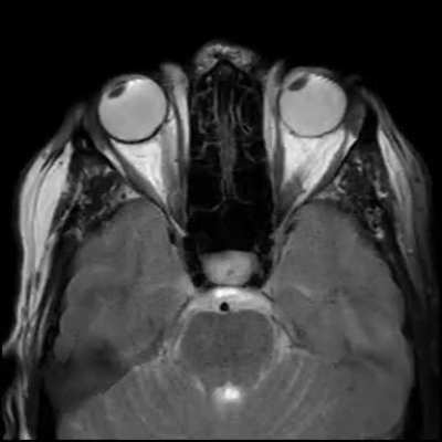 MRI scan of a person moving their eyes back and forth.