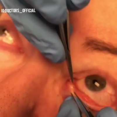 Thanks, I hate eyelid pop.