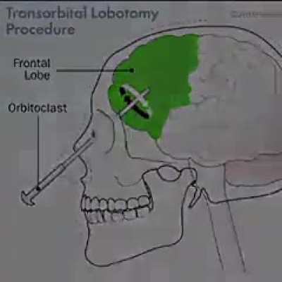 Wunkus lobotomy