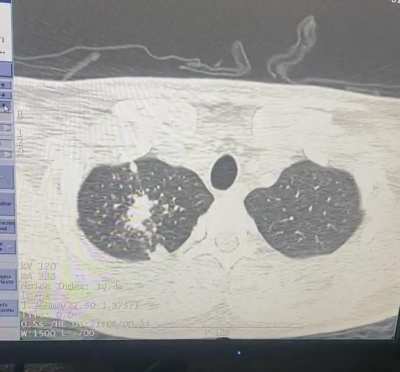 Cavitation