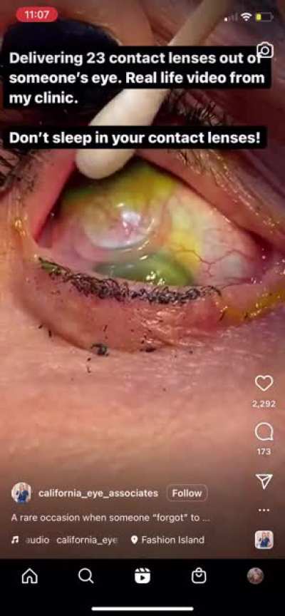 Multiple contacts being delivered from an eyeball. Remember to take out your contacts before bed kids….