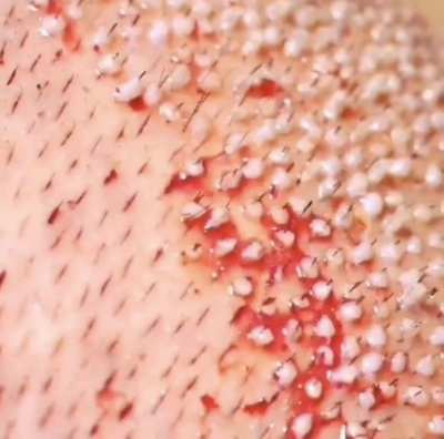hair implants