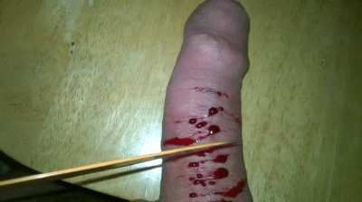 penectomy