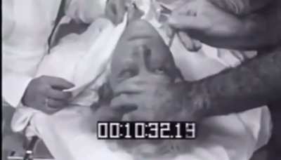 Lobotomy being performed