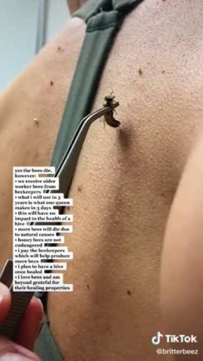 Using bee stings to treat lyme disease