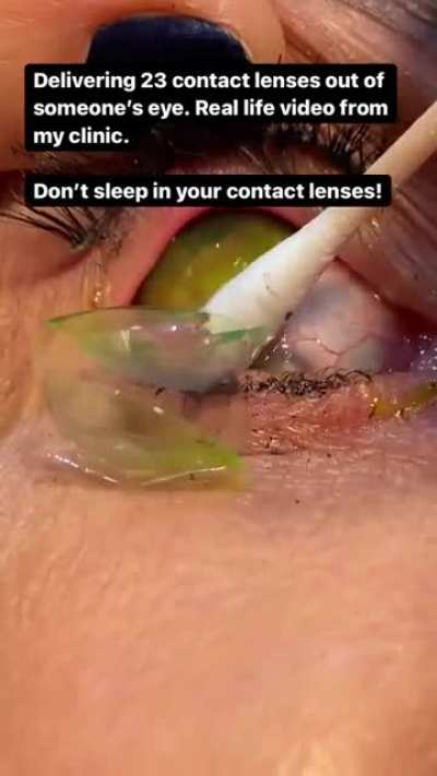 Dr removes 23 contact lenses from eye of a patient who just forgot them
