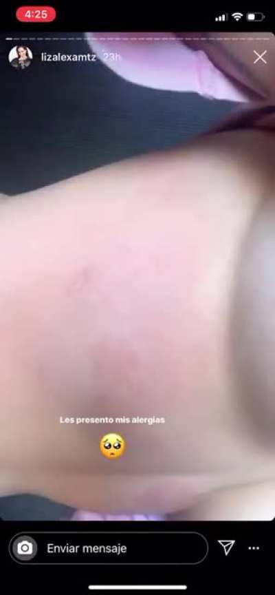 Les presento sus alergias
