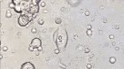 Cancer Cells Being Brutally Destroyed By Genetically Engineered T-cells