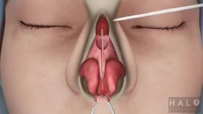 How Rhinoplasty (Nose Job) Is Done
