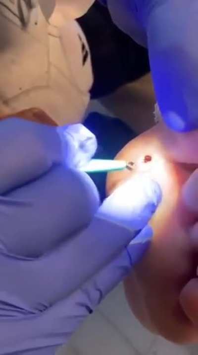 Woah! Splinter removed from foot