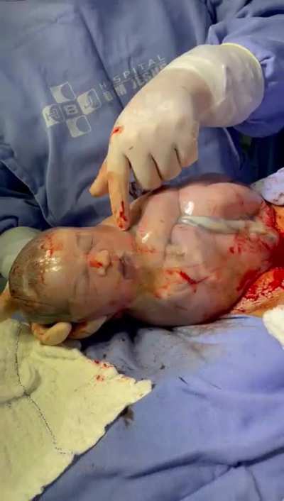 The opening of the eyes to life of this baby born inside an amniotic sac