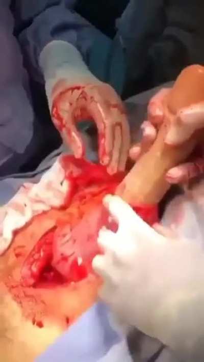 A 55 year old man shocked the medical staff when he came to the hospital with severe abdominal pain, after filming it was found that there was a large object stuck in the rectum, and the medical team needed to perform surgery to extract this..