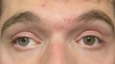 Update II Congenital Nystagmus and Heterochromia in Ocular Albinism (OA1) due to GPR143 mutation. BCVA 20/100 and total foveal hypoplasia.