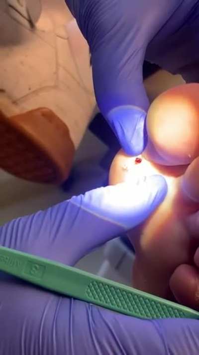 Got a little something stuck in the foot...