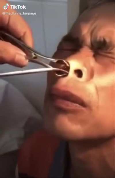 Nose Leech?!