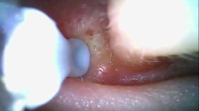 Explosive Ear Pop!