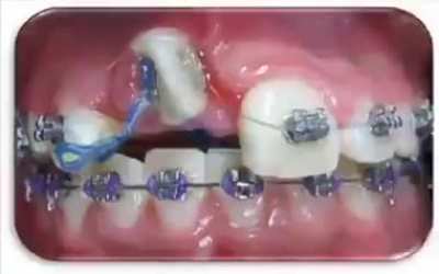 Gross yet fascinating. Wait till the end, modern dentistry is amazing!