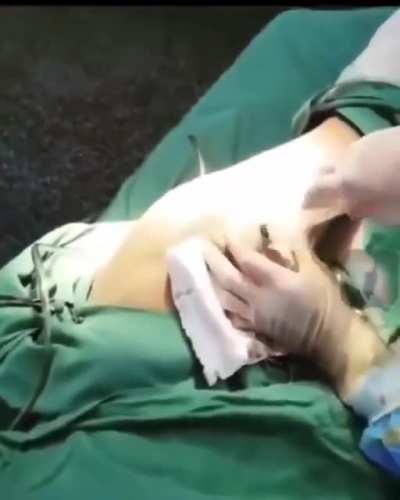 Septic arthritis