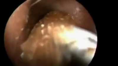 Roach in the ear