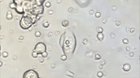 Cancer Cells Destroyed by T-cells