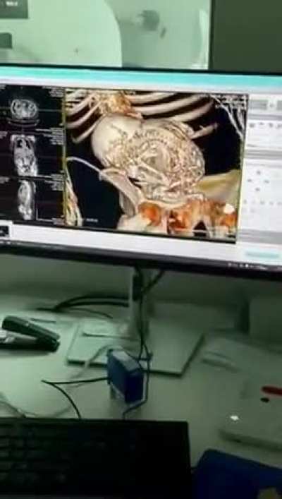 Patient went for a bladder stone turns out it’s a Calcified baby never birthed