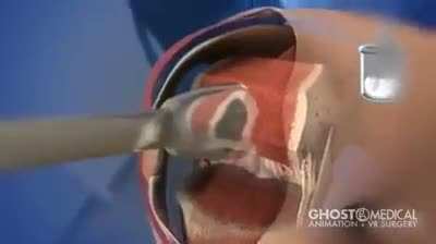 How Knee Replacement Surgery works