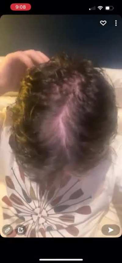 I’m 17, is this male pattern balding
