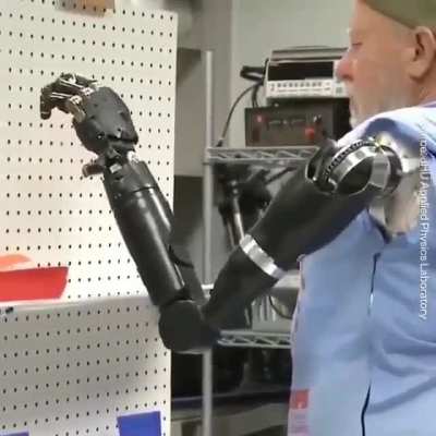 American Forest Bof lost both hands in a car accident, he was offered an experimental operation he could not refuse