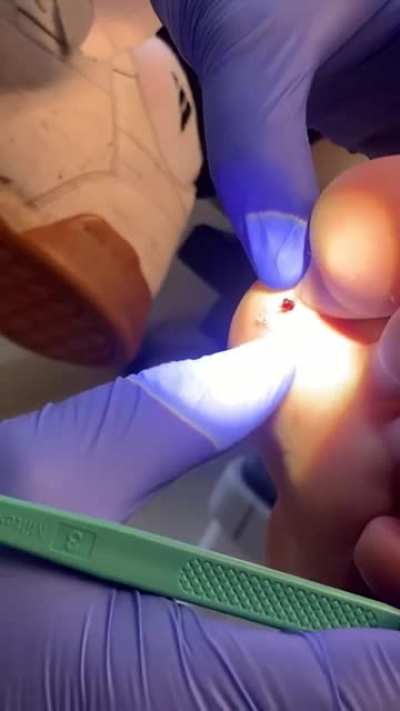 Splinter removal.