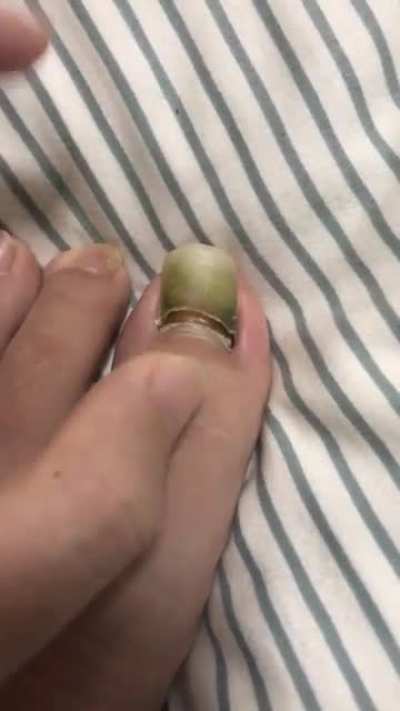 Finally lost my toenail