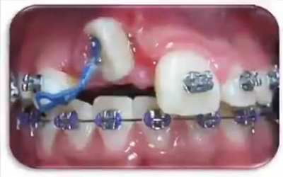 A time lapse of braces straightening teeth
