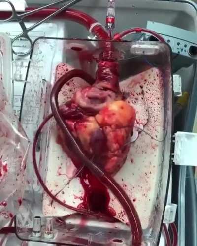 Video of a beating heart awaiting transplant!! This donor's heart is using the Organ Transplant System, Heart<wbr>-in-a<wbr>-Box.