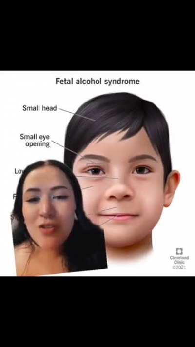 Fetal alcohol syndrome