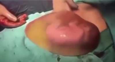 Newborn kicks, nestles onto mother while still inside the amniotic sac.