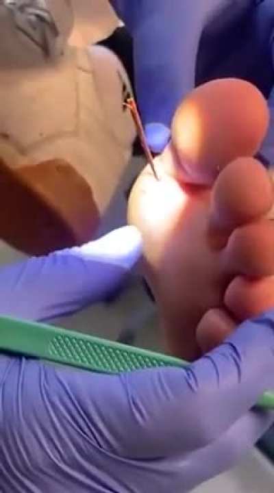Jake was complaining about a “splinter” in his foot…