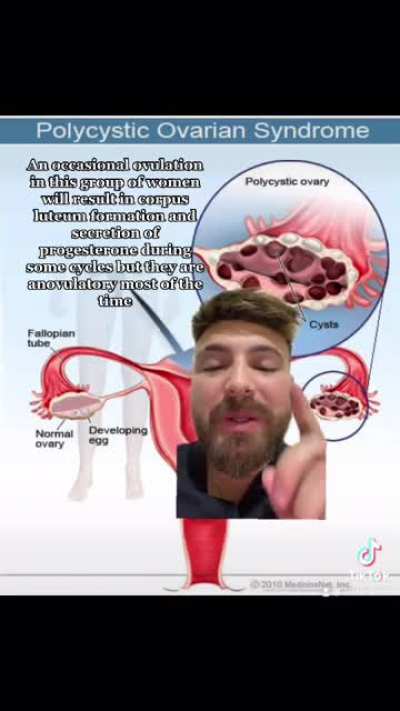 Hello guys ( i guess girls in this case 😂),here is a video to explain PCOS for curious people and those affected by it, hope you enjoy it, any constructive feedback is welcome 😌