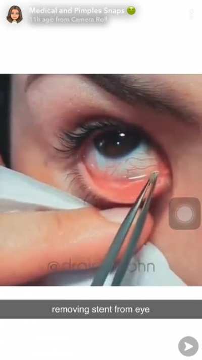 Why does my eye hurt after watching this?