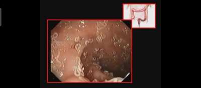 If you ever feel something bad in your stomach or Anal region or anywhere in body . Never delay to meet a doctor,So that you will not end up like this.<wbr>____P<wbr>ingwo<wbr>rms__<wbr>_-_-_<wbr>-_-_O<wbr>LD VID