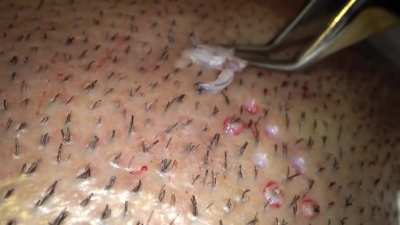Hair Transplant Follicular Unit Extraction
