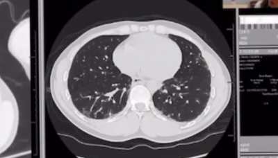 Diagnosed with idiopathic interstitial lung disease. Never smoke a day in my life nor have I ever worked in hazardous environments.