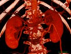 Leriche syndrome