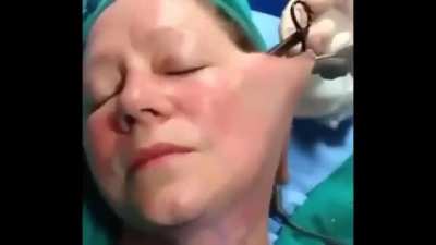 I understand an awake facelift but is this really how you stretch the skin?
