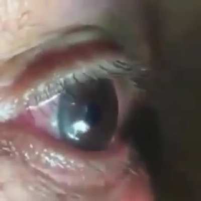A live parasitic worm being removed from a man’s eye