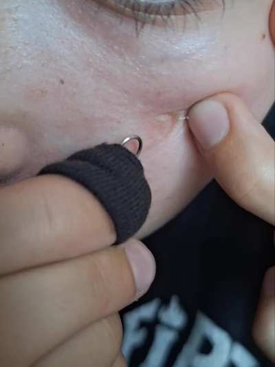 A little gnarly pimple on my cheek, it will probably come back (OC)