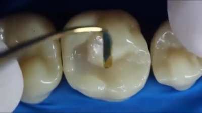 Filling In A Dental Filling Using “Composite Fillings”